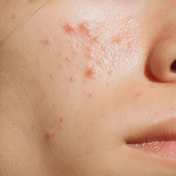 Acne & Blemishes: What's Really Causing Your Breakouts (And How to Clear Them)